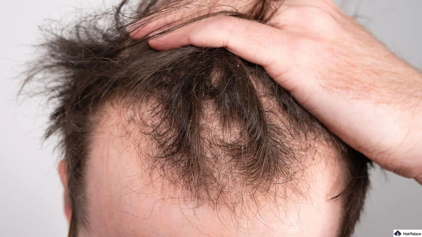 Best Shampoo For Thinning Hair For Men: What Actually Works?